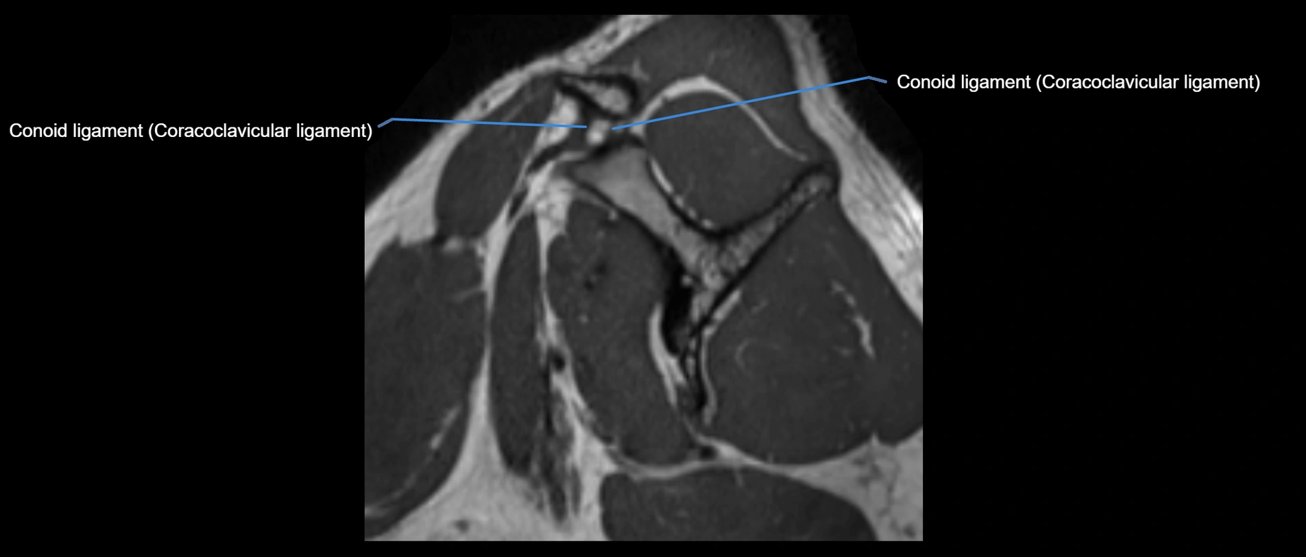 shoulder ligaments sagittal  cross sectional anatomy 3T MRI AI enhanced radiology image -img-00001-00014.webp